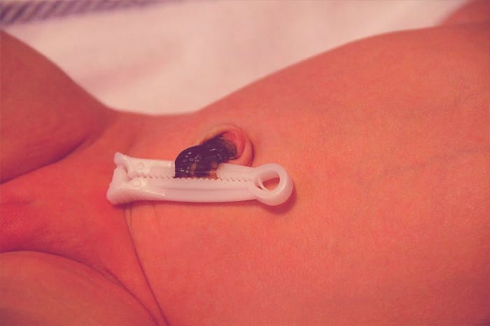 iFraldas.com.br - cuidados com o umbigo do bebê